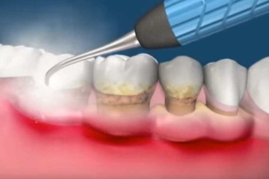 Классификация пародонтита: подробный отчет - parodont.pro