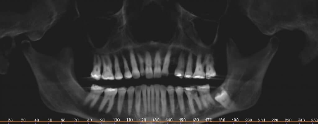 Могут ли фолликулярные кисты быть множественными стоматология