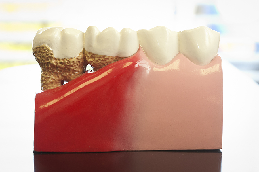 Воспаление тканей пародонта: 4 стадии патогенеза - parodont.pro