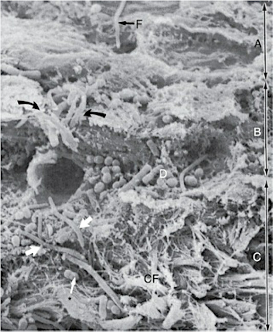 Электронная микрофотография среза стенки пародонтального кармана
