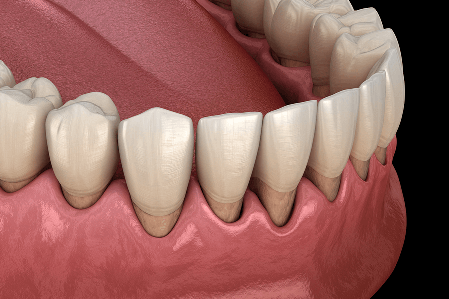 Абфракционные дефекты: этиология, диагностика и методы лечения ...