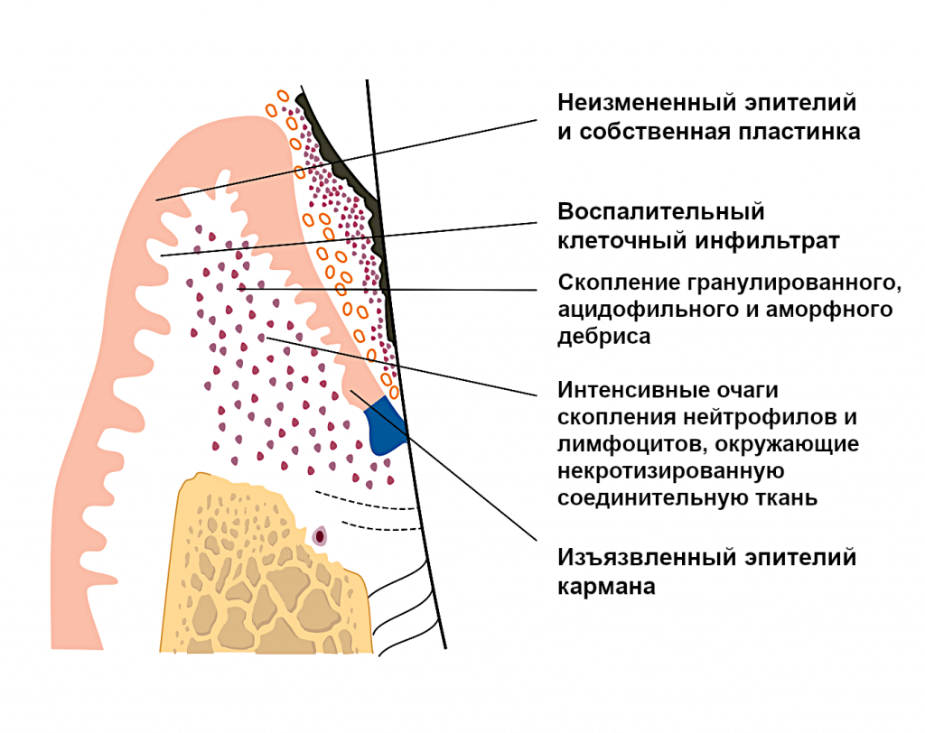 пародонтальные абсцессы