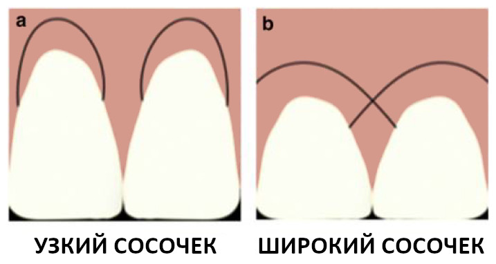 Типы сосочков