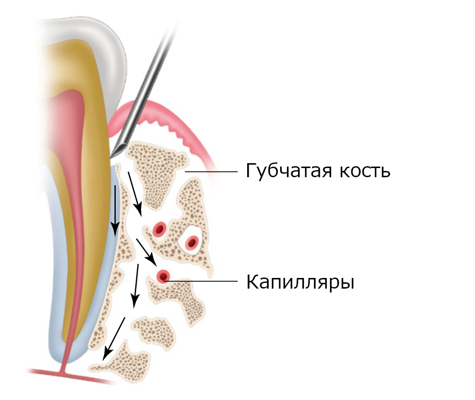 Показана диффузия анестетика вдоль периодонтальной связки и вдоль фенестраций в альвеолярной кости и субпериостальных отверстий