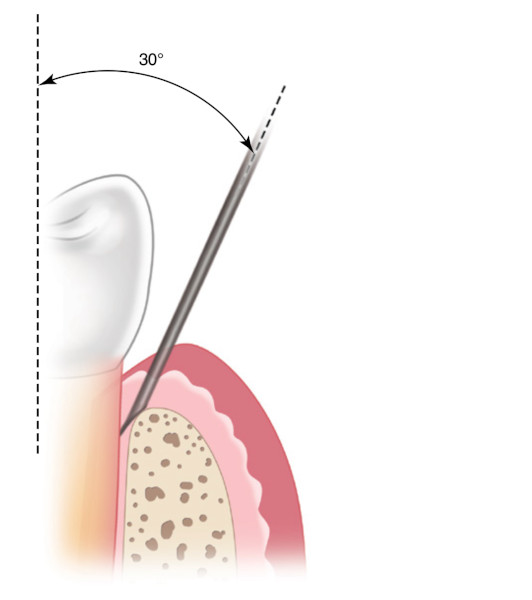 2. Показан угол 30° по отношению к оси зуба при введении иглы. Обратите внимание, что скос иглы повернут наружу