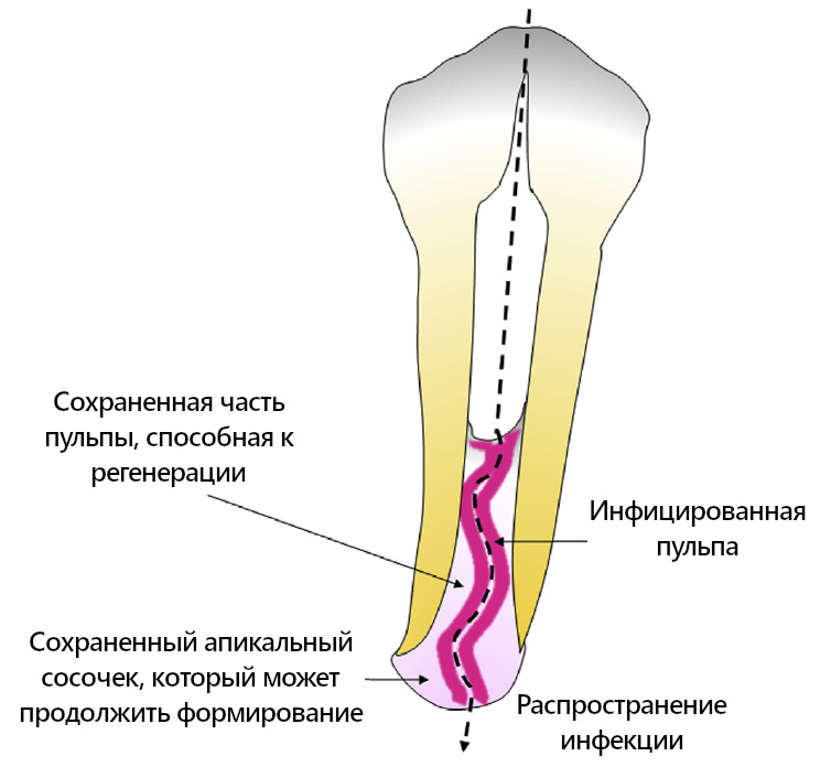 Гипотетический инфекционный процесс и путь проникновения инфекции в периапикальную область зуба с «dens evaginatus».