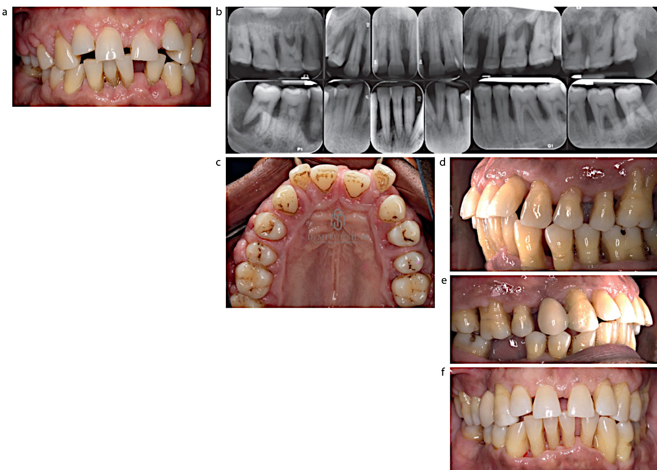 Рисунок 3. (a-c) Клиническая и рентгенографическая картина пациента с тяжелым пародонтитом (IV стадии) и лекарственно-индуцированным зарастанием десны. Зубы 14, 27, 48, 46 имели пародонтальные поражения и были удалены на втором этапе пародонтальной терапии. (d-f) Картина после завершения лечения. Для замещения зуба 14 был установлен адгезивный мостовидный протез