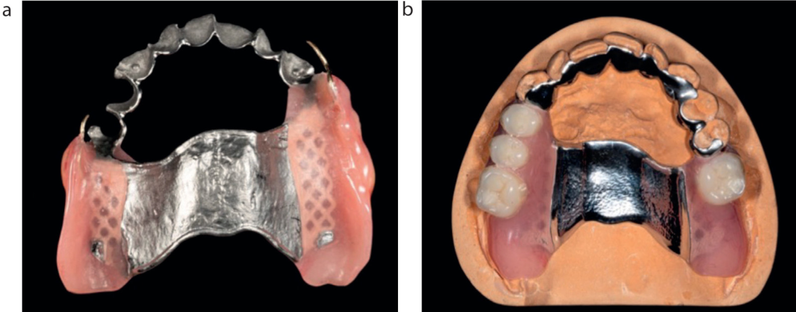 Рисунок 5. (a, b) Демонстрация конструкции постоянного протеза для пациента с пародонтитом IV стадии с двусторонним неограниченным дефектом зубного ряда. Каркас был разработан с учетом оптимизации гигиены полости рта.
