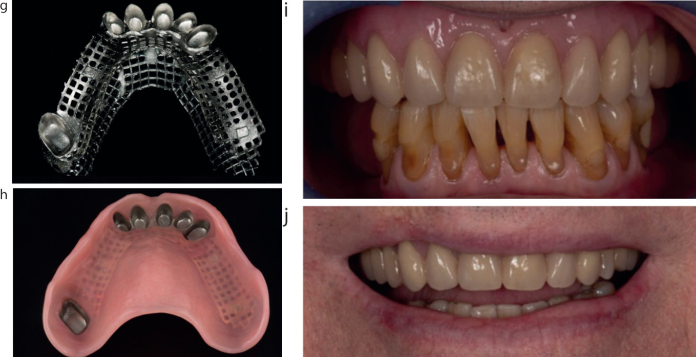 Рисунок 6. (a,b) Пациент с тяжелым пародонтитом (IV стадии) с тотальной стираемостью. (c) Восковая модель предполагаемой конструкции протеза. (d) Препарирование зубов (до этого было проведено лечение корневых каналов). (e,f) Телескопические коронки на моделях и в полости рта (g,h) Каркас и внутренняя поверхность протеза. (i,j) Вид протеза в полости рта