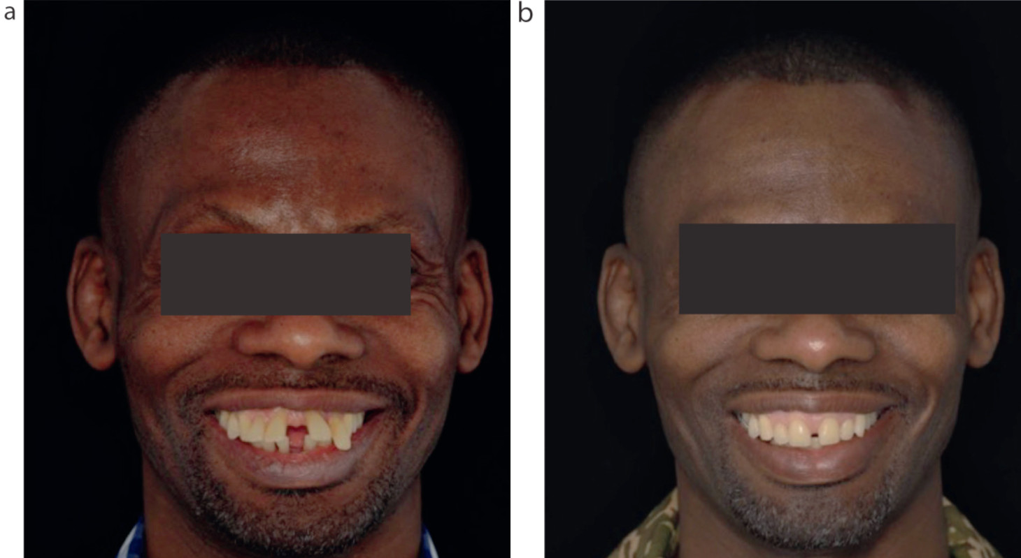 Рисунок 7. (a,b) Успешное лечение тяжелого пародонтита (IV стадии) связан с улучшениями эстетики и функции, а также способствует улучшению общего здоровья пациента