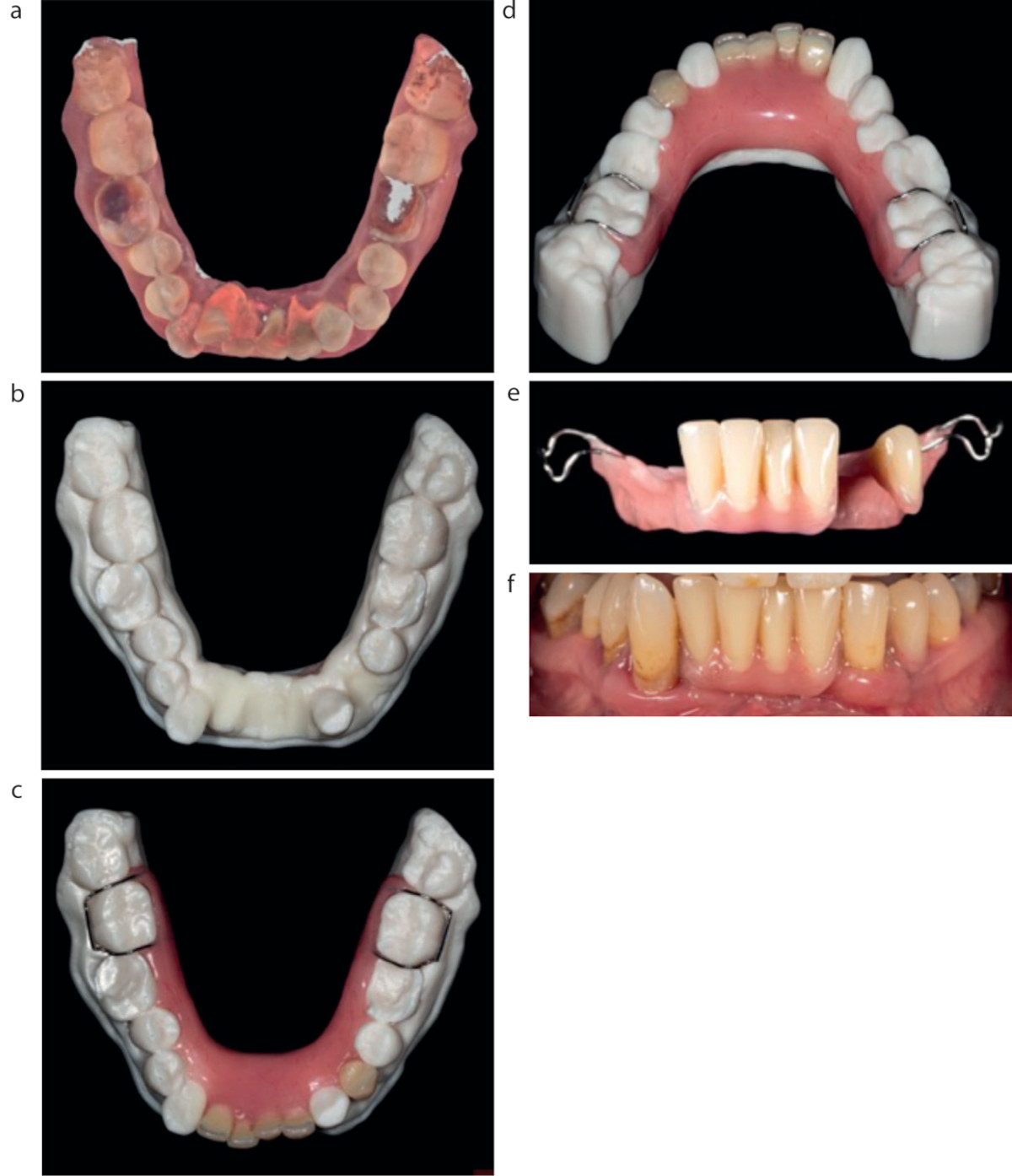 (а) Внутриротовой снимок пациента с безнадежным прогнозом нижних резцов. (b) сняты оттиски и изготовлены диагностические модели. (c, d) Окклюзионный и язычный вид установленного протеза. В данном случае в качестве ретенционных элементов на нижних молярах были использованы кламмеры Адамса. (e) Вестибулярный вид протеза. (f) Протез в полости рта.