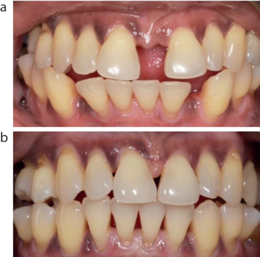 Случай стабилизированного пародонтита, требующий ретрузивного ортодонтического перемещения. (a) до ортодонтического лечения. (b) после ортодонтического лечения