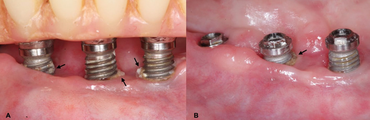 a, b - имплантаты с открытыми поверхностями витков, что способствует накоплению налета и образованию камней (указано стрелками)