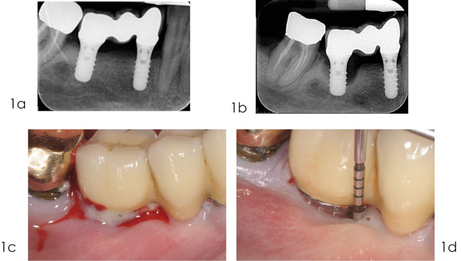Реконструктивное лечение периимплантита: диагностический этап