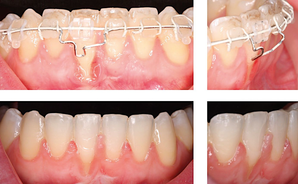 Пациент по завершении ортодонтического лечения обратился с выраженной рецессией десны на нижнем правом центральном резце