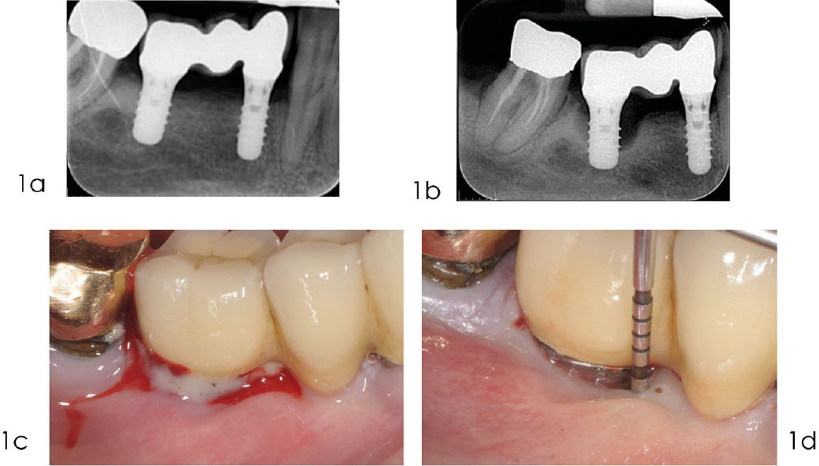 Реконструктивное лечение периимплантита: диагностика