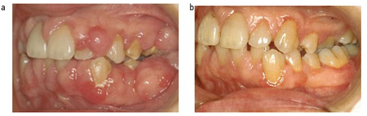 (a) Разрастание десны, связанная с приёмом фенитоина; (b) После проведения нехирургического и хирургического пародонтологического лечения
