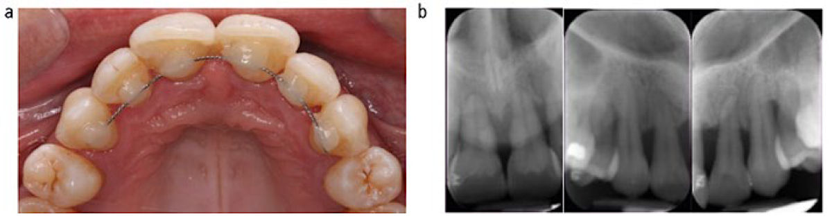 (a) Тяжёлый случай пародонтита с дуговой шиной и композитом; (b) Рентгенограммы до лечения