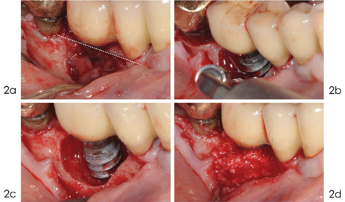 Реконструктивное лечение периимплантита 1 блок