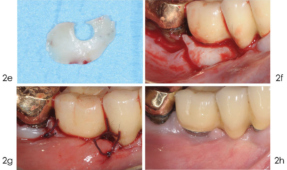 Реконструктивное лечение периимплантита Блок 2
