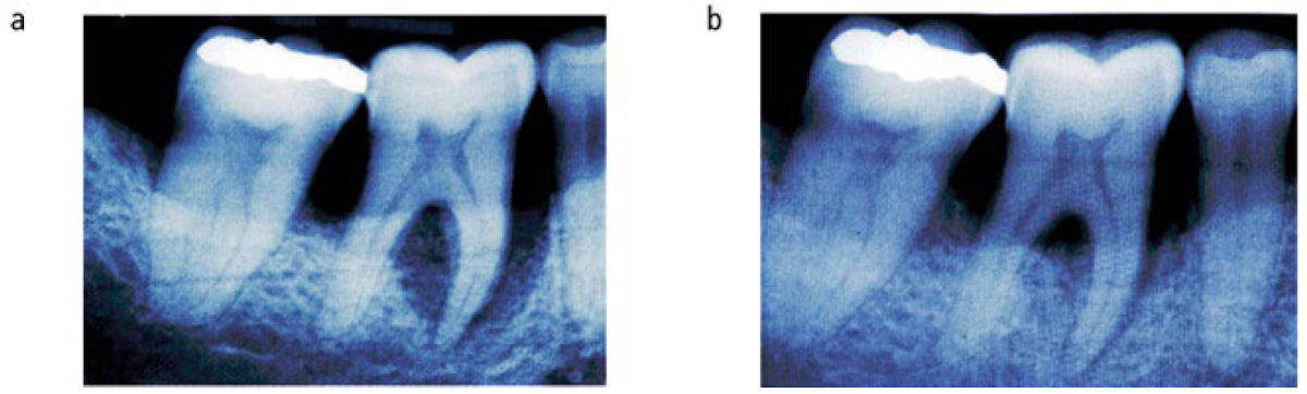 Нехирургическое пародонтологическое лечение: (a) До лечения; (b) Через шесть месяцев после лечения