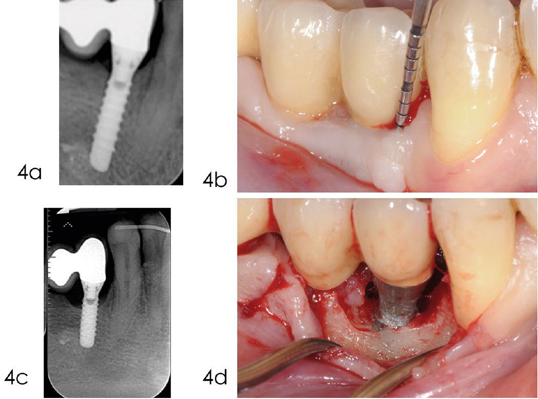 Обработка с доступом через лоскут