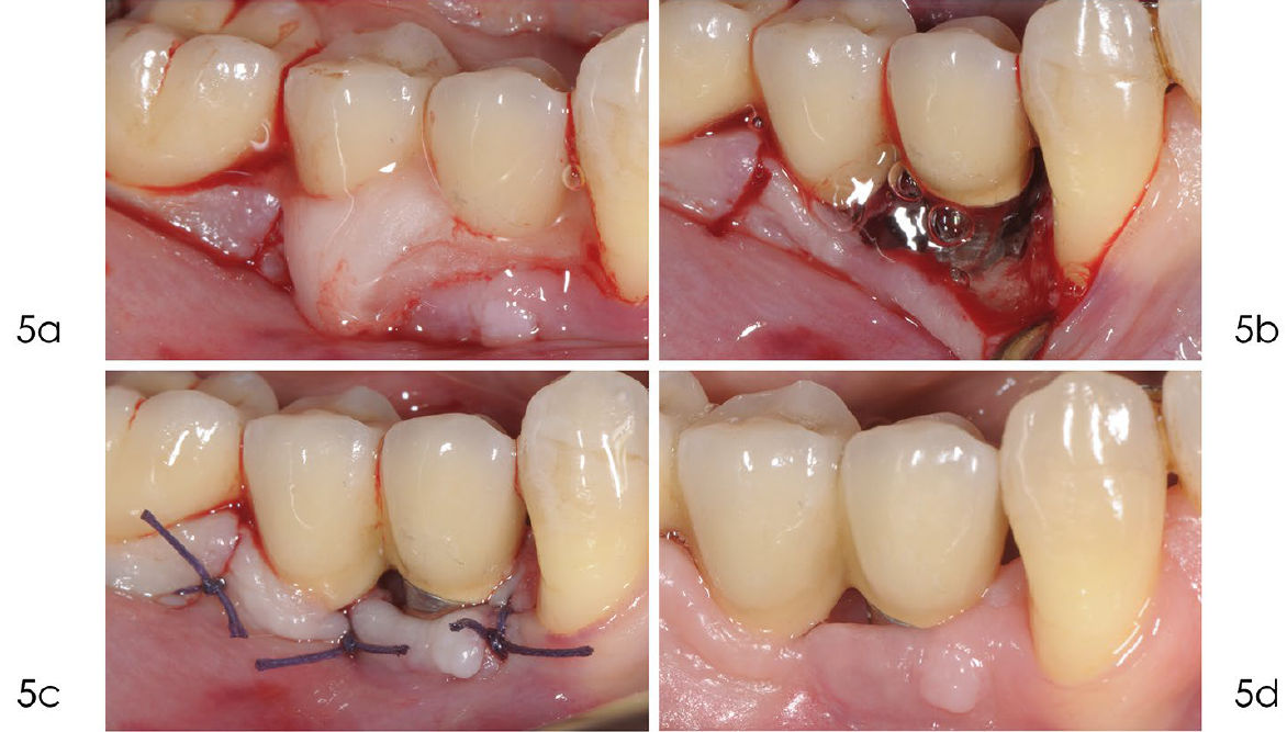 После удаления грануляционной ткани поверхность имплантата