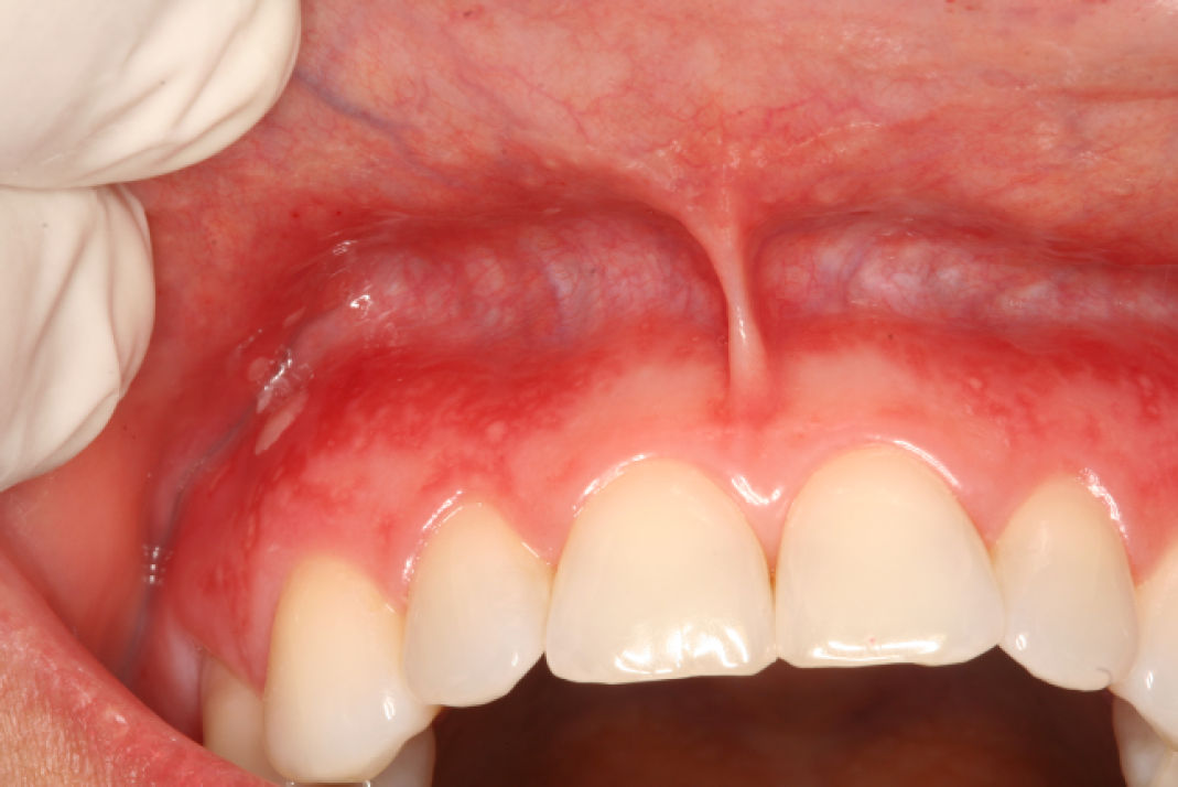 Множественные мелкие округлые язвы на прикреплённой вестибулярной десне верхней челюсти и прилежащей слизистой оболочке губы