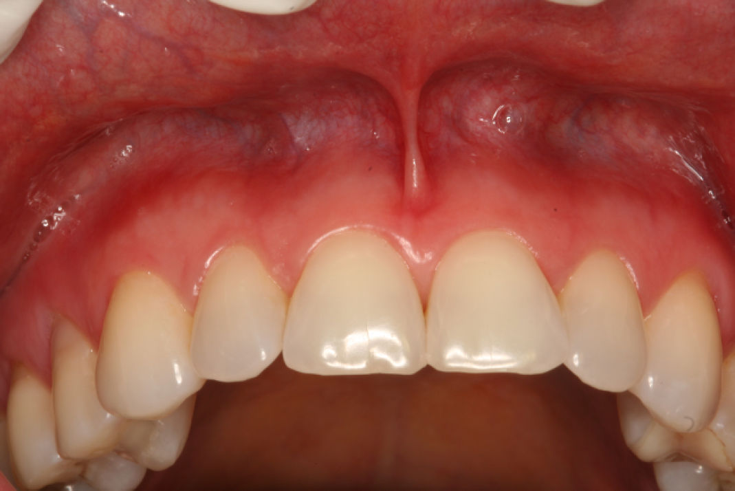 Через 3 дня после прекращения использования зубной пасты, отмечается полное исчезновение поражений