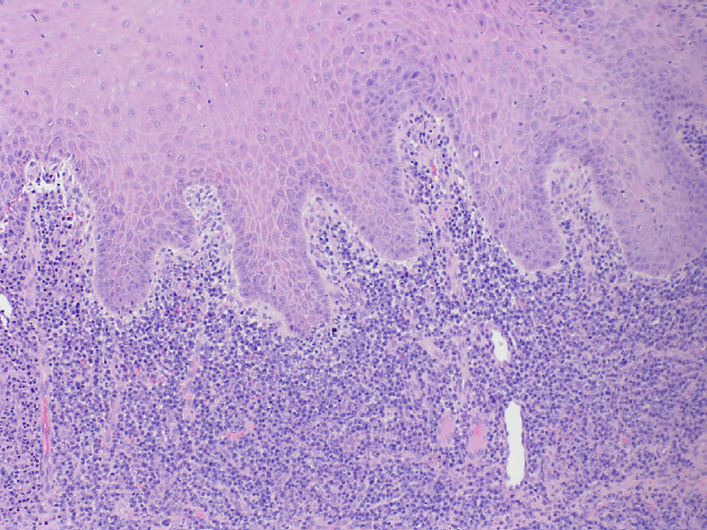 Микроскопическое исследование выявило выраженную инфильтрацию хроническими воспалительными клетками