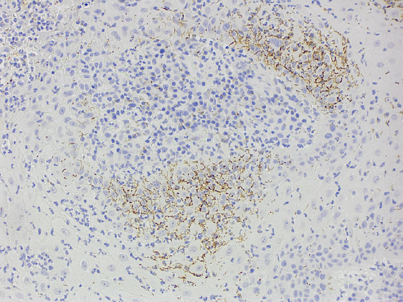 Иммуногистохимическое окрашивание выявило большое количество спирохет в пределах эпителия