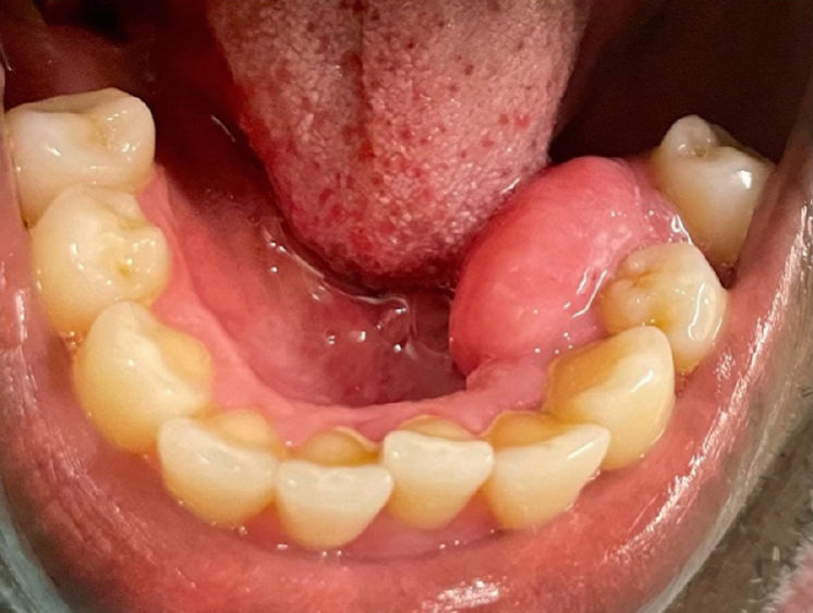 Клиническая фотография десневого образования на язычной поверхности