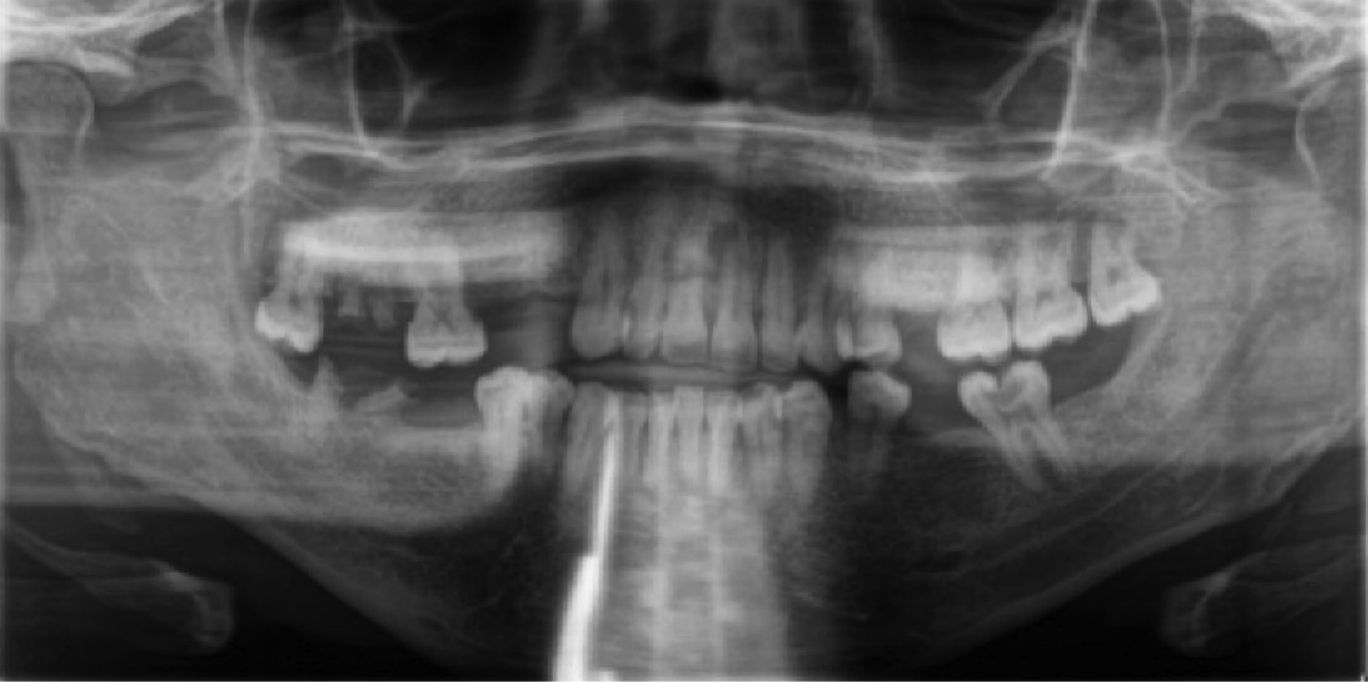 Панорамная рентгенограмма, демонстрирующая смещение зуба 35, кариозное поражение зуба 37, отсутствие нескольких зубов и наличие множественных корней