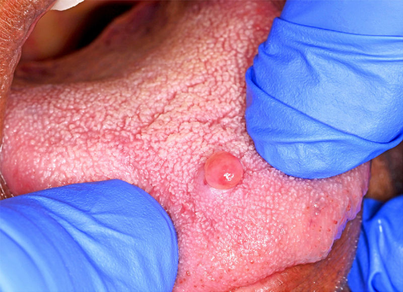 Клиническая фотография красновато-розового, изъязвлённого, сидячего узлового образования размером приблизительно 0,8 × 0,5 см, расположенного в средней передней части дорсальной поверхности языка