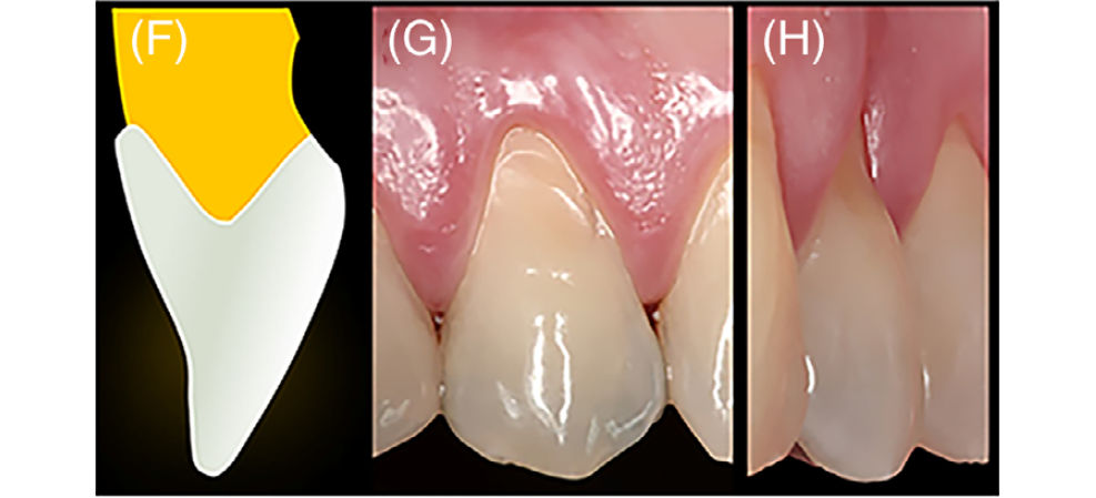 Вид поверхности зуба типа B−