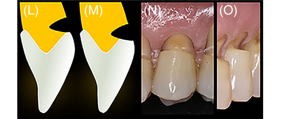 Вид V-образных поражений: A+ (L) и B+ (M).