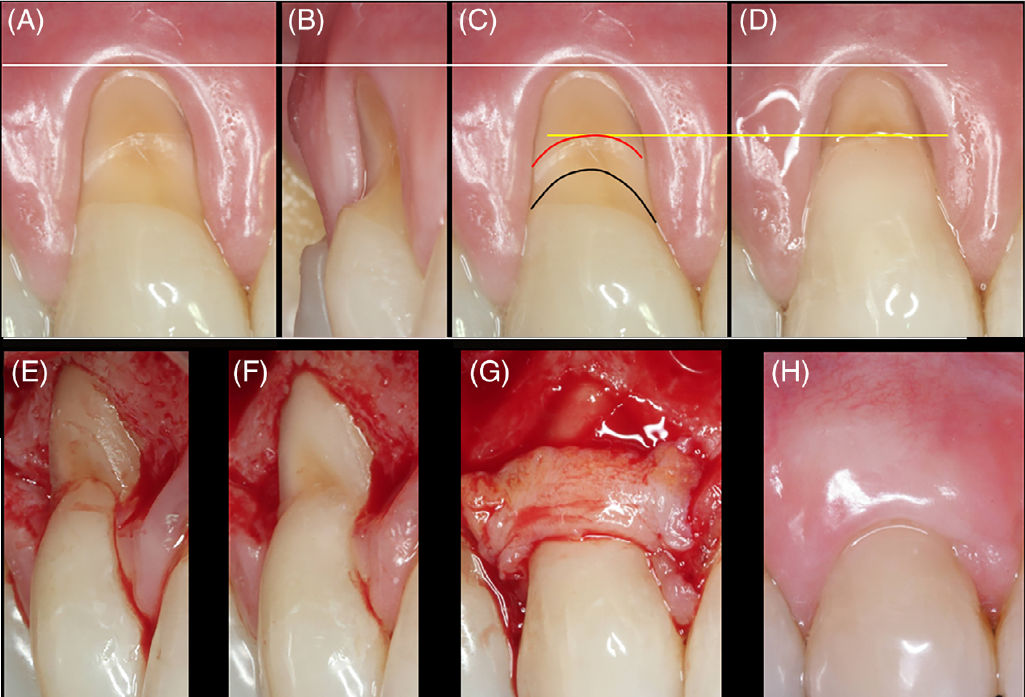 Типичный случай рецессии десны RT1 и некариозного пришеечного поражения B+
