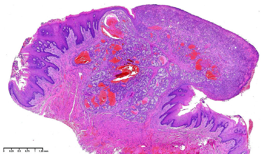 Микрофотография при малом увеличении, демонстрирующая отграниченную, неинкапсулированную пролиферацию атипичных полигональных эпителиальных клеток, погружённых в высоковаскуляризированную фиброзную строму (гематоксилин-эозин, увеличение ×2)