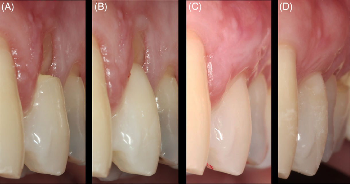Типичный случай рецессии десны RT1 и NCCL типа B+ с 7-летним периодом наблюдения