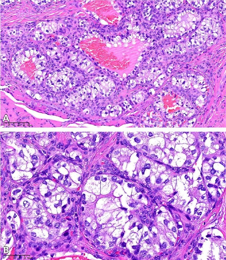 Микрофотография при большом увеличении, демонстрирующая эпителиальные клетки, расположенные в виде компактных гнёзд с очаговыми трубчатыми или микрокистозными структурами