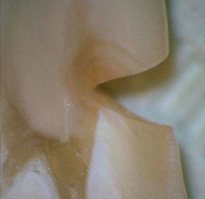 Типичный случай V-образного некариозного пришеечного поражения