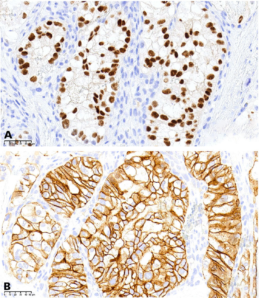 Клетки поражения, демонстрирующие выраженное ядерное иммуногистохимическое окрашивание (парный боксовый ген 8, увеличение ×40) (A) и мембранную иммунореактивность (карбоангидраза 9, увеличение ×40) (B)