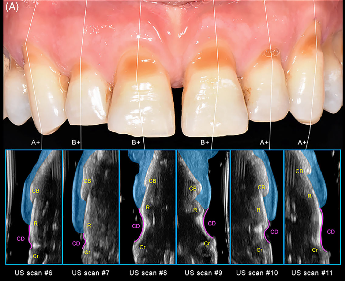 Ультразвуковая характеристика пародонтальных структур передних зубов верхней челюсти