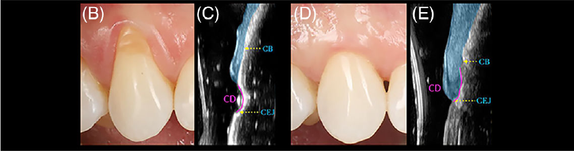 Типичный случай RT1 и NCCL типа A+