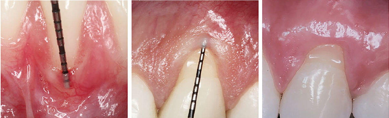 Алгоритм принятия решений при лечении рецессионного компонента в комбинированных дефектах