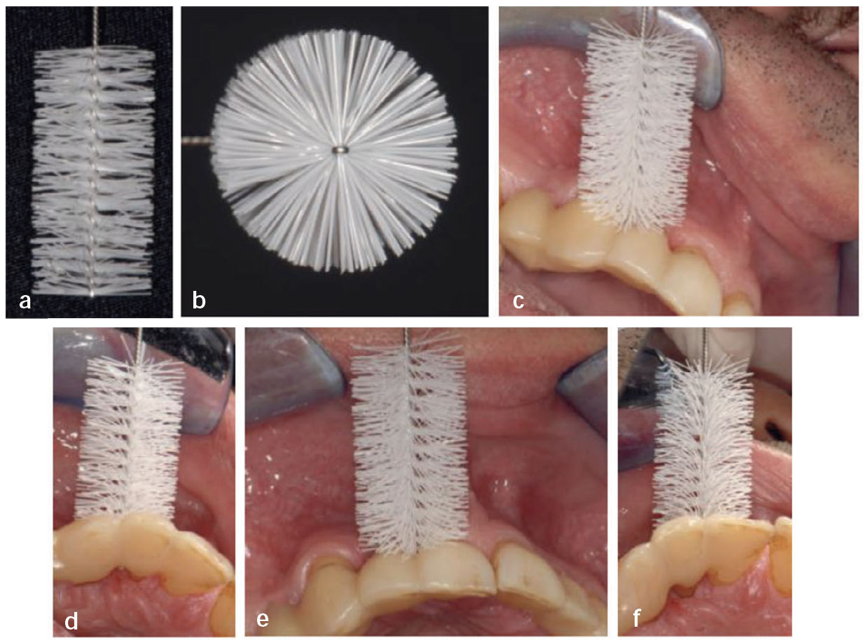 Подбор межзубных ёршиков с боковыми щетинками