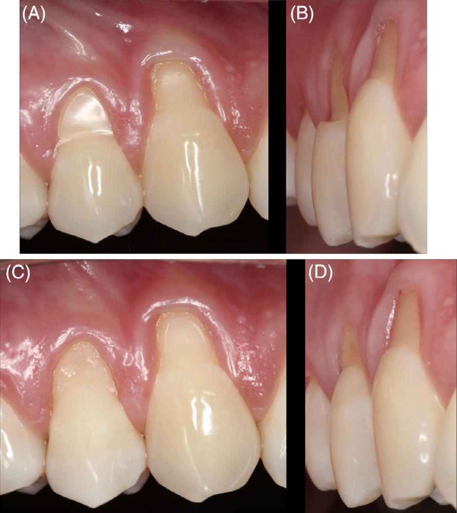 Клинический случай комбинированного дефекта (CD) класса B+ на премоляре