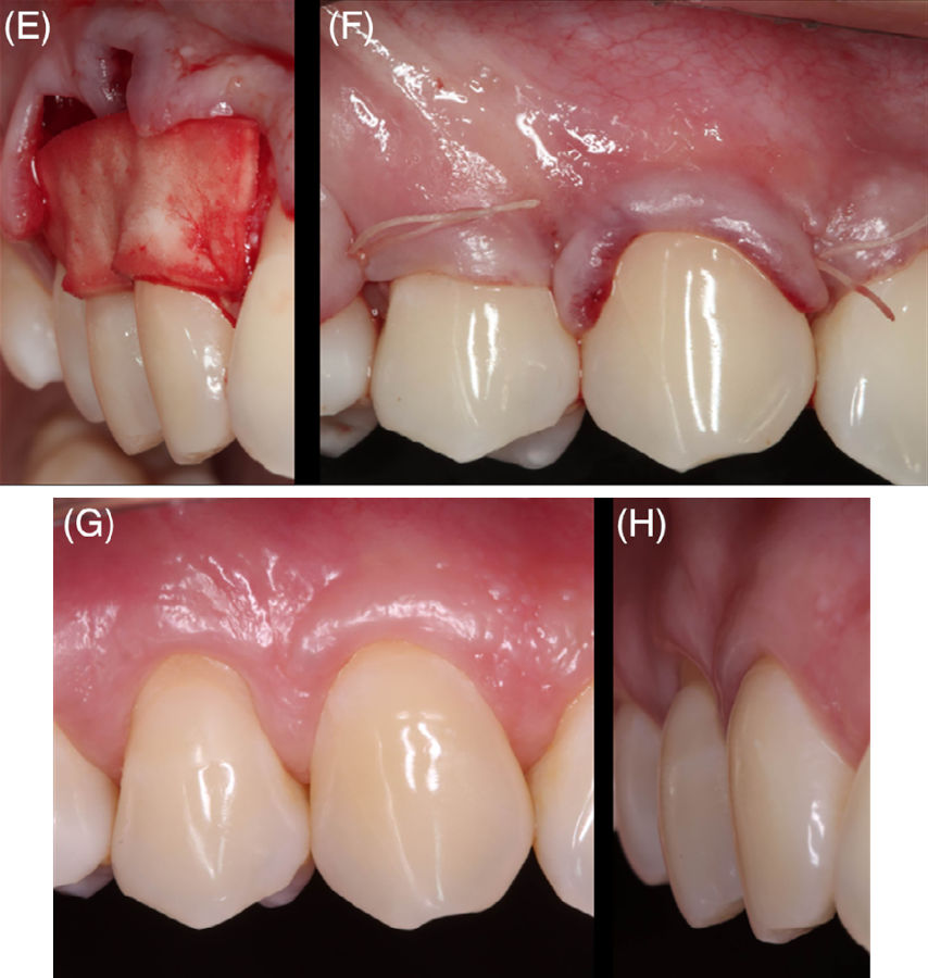 Клинический случай комбинированного дефекта (CD) класса B+ на премоляре. Фото E-H