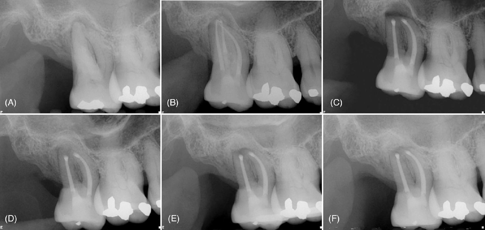 Периапикальные рентгенограммы зуба 17 с рентгенопрозрачным очагом
