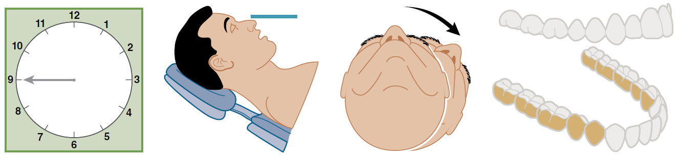 Дистальные участки нижней челюсти, обращённые к врачу